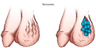 Illustration for article titled Obat Alami Varikokel Ringan